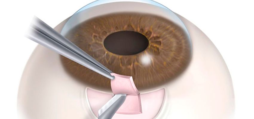 Cirurgia de Glaucoma (trabeculectomia- TREC)