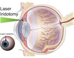 Iridotomia a laser para glaucoma