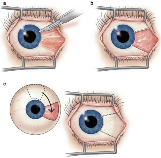 Cirurgia de Pterígio com auto transplante conjuntival e cola biológica (sem pontos)