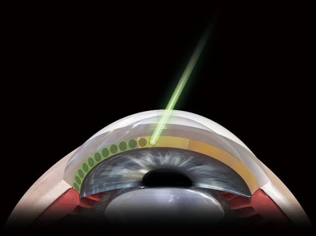 Cirurgia a laser para glaucoma (trabeculoplastia seletiva – SLT)