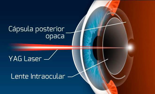  Yag Laser para capsulotomia (limpeza de lente pós cirurgia de catarata)